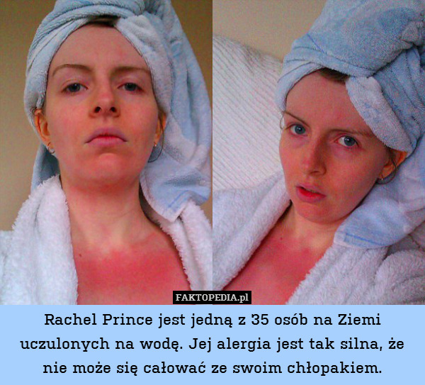 Rachel Prince jest jedną z 35 osób na Ziemi uczulonych na wodę. Jej alergia jest tak silna, że nie może się całować ze swoim chłopakiem. 