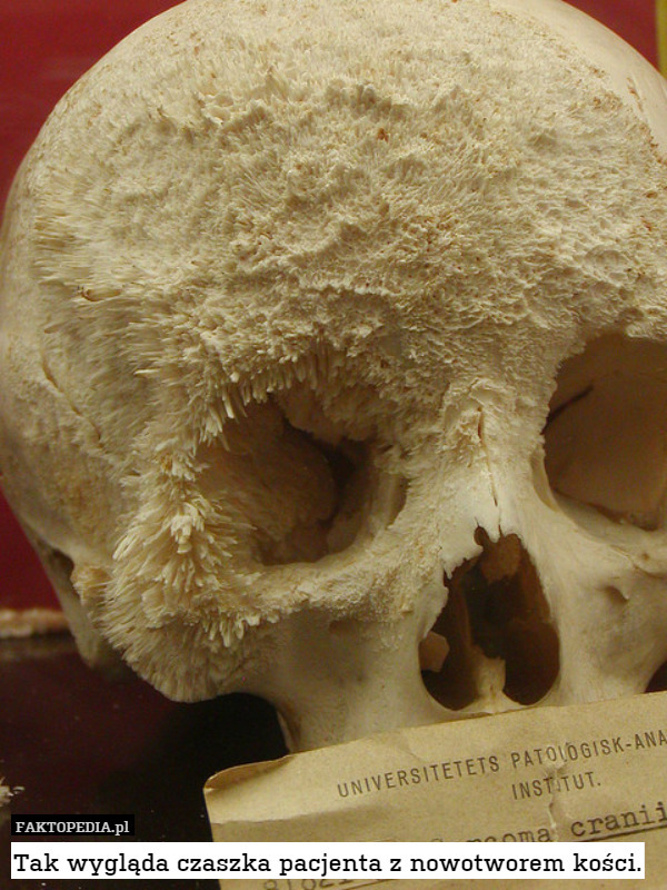 Tak wygląda czaszka pacjenta z nowotworem kości. 