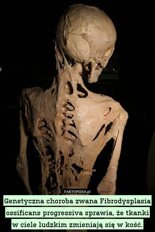 Genetyczna choroba zwana Fibrodysplasia ossificans progressiva sprawia, że tkanki w ciele ludzkim zmieniają się w kość. 