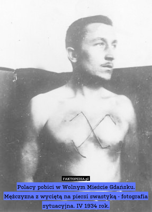 Polacy pobici w Wolnym Mieście Gdańsku. Mężczyzna z wyciętą na piersi swastyką - fotografia sytuacyjna. IV 1934 rok. 