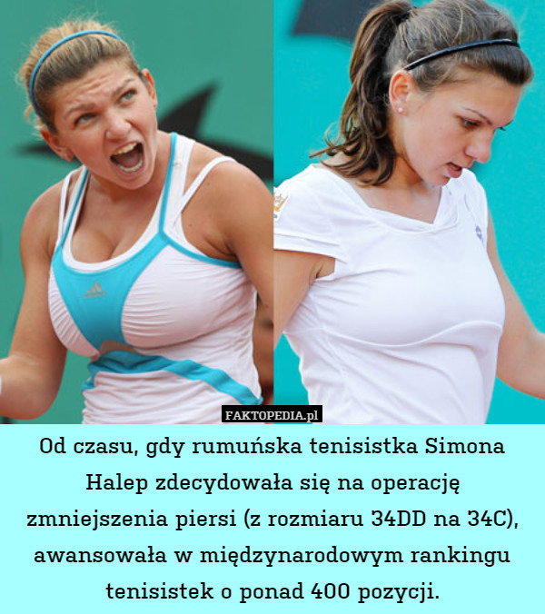 Od czasu, gdy rumuńska tenisistka Simona Halep zdecydowała się na operację zmniejszenia piersi (z rozmiaru 34DD na 34C), awansowała w międzynarodowym rankingu tenisistek o ponad 400 pozycji. 