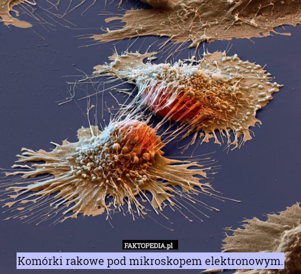 Komórki rakowe pod mikroskopem elektronowym. 