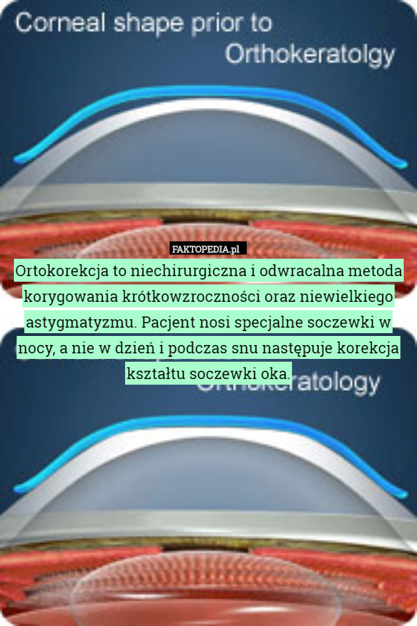 Ortokorekcja to niechirurgiczna i odwracalna metoda korygowania krótkowzroczności oraz niewielkiego astygmatyzmu. Pacjent nosi specjalne soczewki w nocy, a nie w dzień i podczas snu następuje korekcja kształtu soczewki oka. 