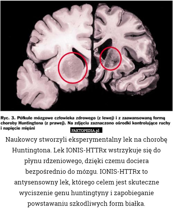 Naukowcy stworzyli eksperymentalny lek na chorobę Huntingtona. Lek IONIS-HTTRx wstrzykuje się do płynu rdzeniowego, dzięki czemu dociera bezpośrednio do mózgu. IONIS-HTTRx to antysensowny lek, którego celem jest skuteczne wyciszenie genu huntingtyny i zapobieganie powstawaniu szkodliwych form białka. 