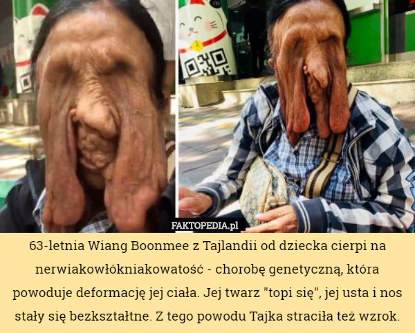 63-letnia Wiang Boonmee z Tajlandii od dziecka cierpi na nerwiakowłókniakowatość - chorobę genetyczną, która powoduje deformację jej ciała. Jej twarz "topi się", jej usta i nos stały się bezkształtne. Z tego powodu Tajka straciła też wzrok. 