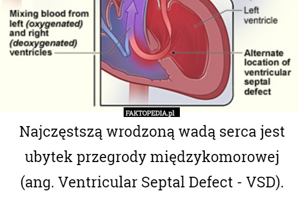 Najczęstszą wrodzoną wadą serca jest ubytek przegrody międzykomorowej (ang. Ventricular Septal Defect - VSD). 