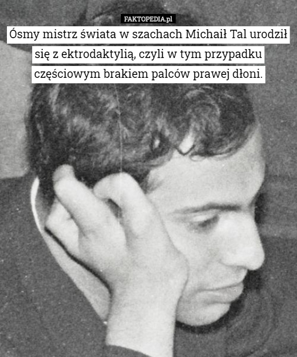 Ósmy mistrz świata w szachach Michaił Tal urodził się z ektrodaktylią, czyli w tym przypadku częściowym brakiem palców prawej dłoni. 