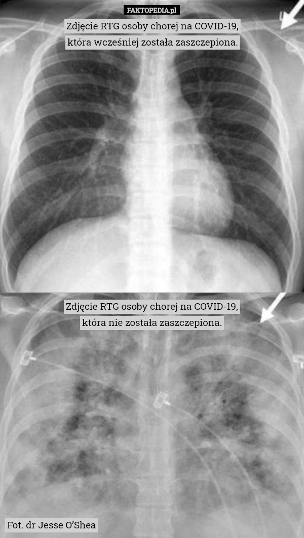 Zdjęcie RTG osoby chorej na COVID-19,
która wcześniej została zaszczepiona. Zdjęcie RTG osoby chorej na COVID-19,
która nie została zaszczepiona. Fot. dr Jesse O’Shea 