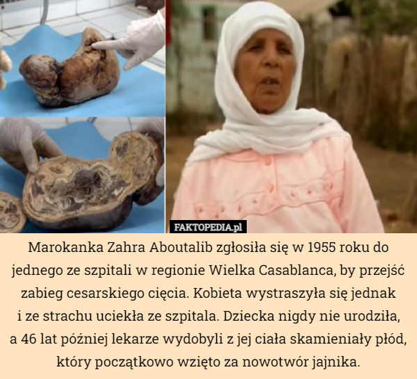 Marokanka Zahra Aboutalib zgłosiła się w 1955 roku do jednego ze szpitali w regionie Wielka Casablanca, by przejść zabieg cesarskiego cięcia. Kobieta wystraszyła się jednak
i ze strachu uciekła ze szpitala. Dziecka nigdy nie urodziła,
a 46 lat później lekarze wydobyli z jej ciała skamieniały płód, który początkowo wzięto za nowotwór jajnika. 