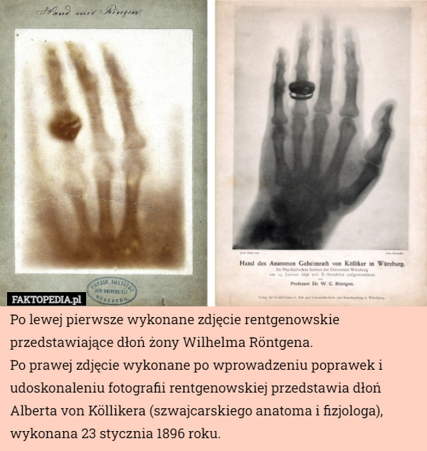 Po lewej pierwsze wykonane zdjęcie rentgenowskie przedstawiające dłoń żony Wilhelma Röntgena.
Po prawej zdjęcie wykonane po wprowadzeniu poprawek i udoskonaleniu fotografii rentgenowskiej przedstawia dłoń Alberta von Köllikera (szwajcarskiego anatoma i fizjologa), wykonana 23 stycznia 1896 roku. 