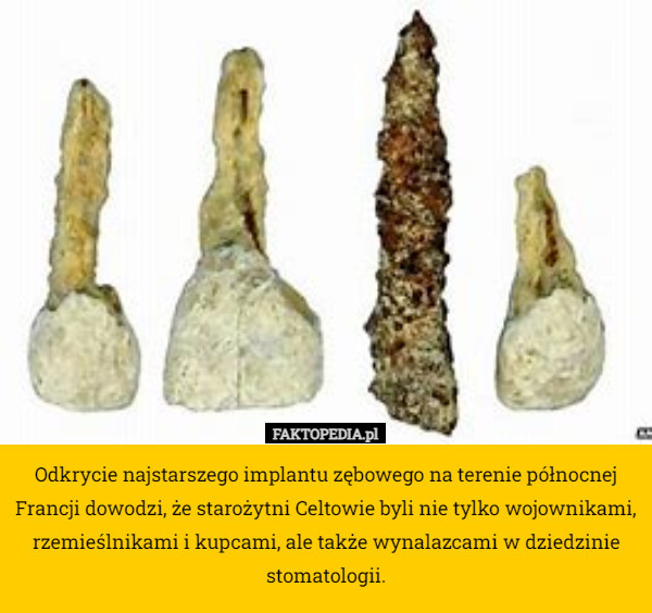 Odkrycie najstarszego implantu zębowego na terenie północnej Francji dowodzi, że starożytni Celtowie byli nie tylko wojownikami, rzemieślnikami i kupcami, ale także wynalazcami w dziedzinie stomatologii. 