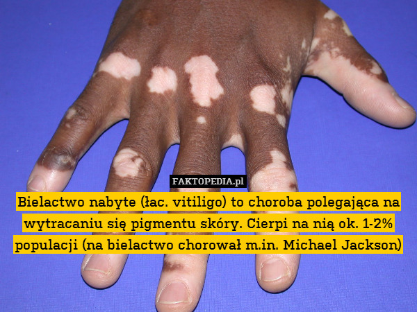 Bielactwo nabyte (łac. vitiligo) to choroba polegająca na wytracaniu się pigmentu skóry. Cierpi na nią ok. 1-2% populacji (na bielactwo chorował m.in. Michael Jackson) 