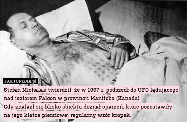 Stefan Michalak twierdził, że w 1967 r. podszedł do UFO lądującego nad jeziorem Falcon w prowincji Manitoba (Kanada).
Gdy znalazł się blisko obiektu doznał oparzeń, które pozostawiły
na jego klatce piersiowej regularny wzór kropek. 