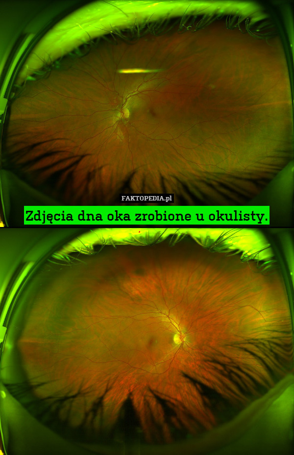 Zdjęcia dna oka zrobione u okulisty. 
