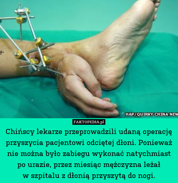 Chińscy lekarze przeprowadzili udaną operację przyszycia pacjentowi odciętej dłoni. Ponieważ nie można było zabiegu wykonać natychmiast po urazie, przez miesiąc mężczyzna leżał
w szpitalu z dłonią przyszytą do nogi. 