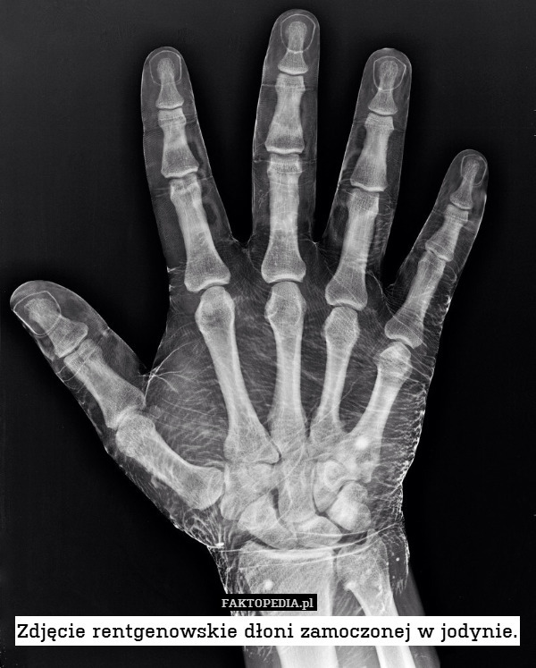 Zdjęcie rentgenowskie dłoni zamoczonej w jodynie. 