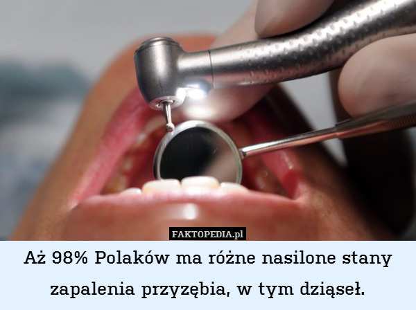 Aż 98% Polaków ma różne nasilone stany zapalenia przyzębia, w tym dziąseł. 