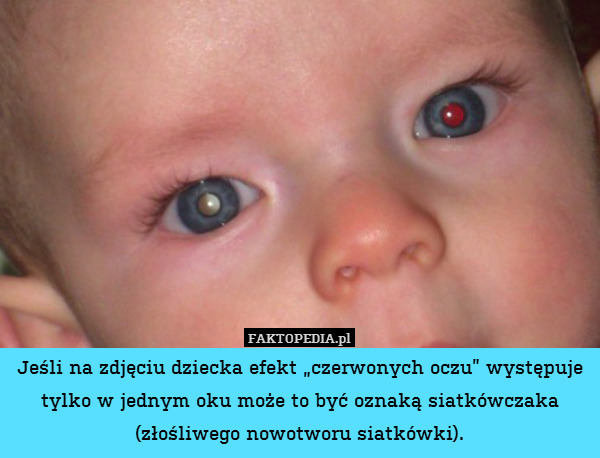 Jeśli na zdjęciu dziecka efekt „czerwonych oczu” występuje tylko w jednym oku może to być oznaką siatkówczaka (złośliwego nowotworu siatkówki). 