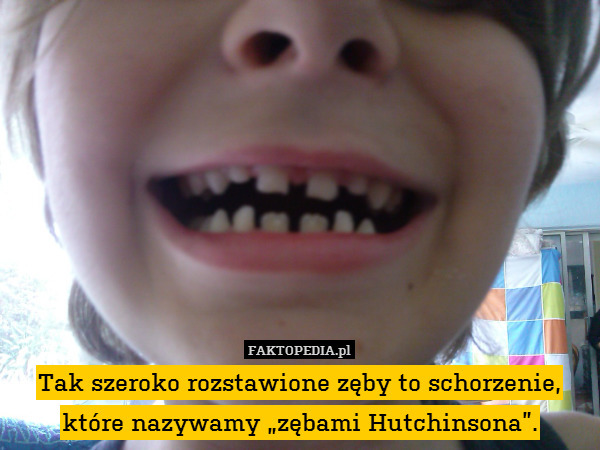 Tak szeroko rozstawione zęby to schorzenie, które nazywamy „zębami Hutchinsona”. 