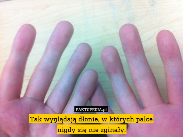 Tak wyglądają dłonie, w których palce
nigdy się nie zginały. 