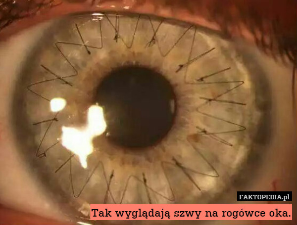 Tak wyglądają szwy na rogówce oka. 