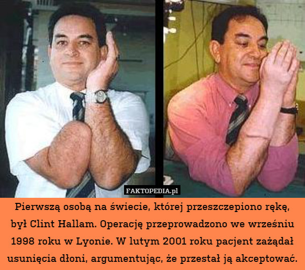 Pierwszą osobą na świecie, której przeszczepiono rękę, był Clint Hallam. Operację przeprowadzono we wrześniu 1998 roku w Lyonie. W lutym 2001 roku pacjent zażądał usunięcia dłoni, argumentując, że przestał ją akceptować. 
