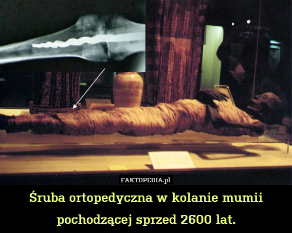 Śruba ortopedyczna w kolanie mumii pochodzącej sprzed 2600 lat. 