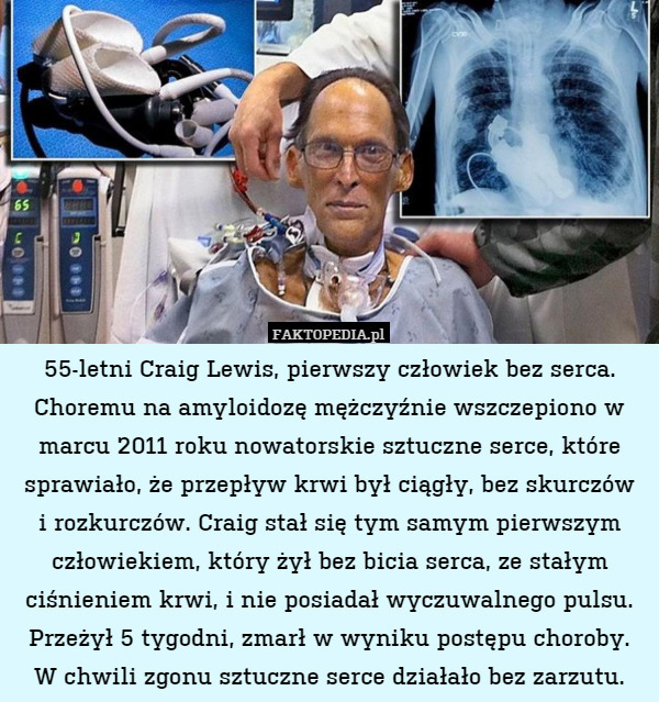 55-letni Craig Lewis, pierwszy człowiek bez serca. Choremu na amyloidozę mężczyźnie wszczepiono w marcu 2011 roku nowatorskie sztuczne serce, które sprawiało, że przepływ krwi był ciągły, bez skurczów
i rozkurczów. Craig stał się tym samym pierwszym człowiekiem, który żył bez bicia serca, ze stałym ciśnieniem krwi, i nie posiadał wyczuwalnego pulsu. Przeżył 5 tygodni, zmarł w wyniku postępu choroby.
W chwili zgonu sztuczne serce działało bez zarzutu. 