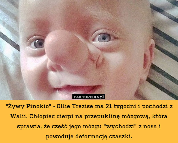 "Żywy Pinokio" - Ollie Trezise ma 21 tygodni i pochodzi z Walii. Chłopiec cierpi na przepuklinę mózgową, która sprawia, że część jego mózgu "wychodzi" z nosa i powoduje deformację czaszki. 