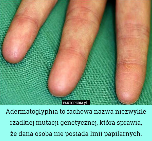 Adermatoglyphia to fachowa nazwa niezwykle rzadkiej mutacji genetycznej, która sprawia,
że dana osoba nie posiada linii papilarnych. 