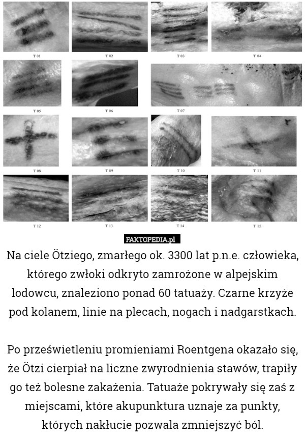 Na ciele Ötziego, zmarłego ok. 3300 lat p.n.e. człowieka, którego zwłoki odkryto zamrożone w alpejskim lodowcu, znaleziono ponad 60 tatuaży. Czarne krzyże pod kolanem, linie na plecach, nogach i nadgarstkach.

Po prześwietleniu promieniami Roentgena okazało się, że Ötzi cierpiał na liczne zwyrodnienia stawów, trapiły go też bolesne zakażenia. Tatuaże pokrywały się zaś z miejscami, które akupunktura uznaje za punkty, których nakłucie pozwala zmniejszyć ból. 