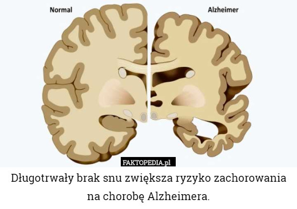 Długotrwały brak snu zwiększa ryzyko zachorowania na chorobę Alzheimera. 