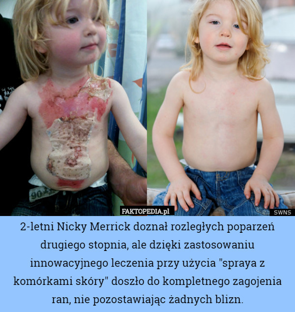 2-letni Nicky Merrick doznał rozległych poparzeń drugiego stopnia, ale dzięki zastosowaniu innowacyjnego leczenia przy użycia "spraya z komórkami skóry" doszło do kompletnego zagojenia ran, nie pozostawiając żadnych blizn. 