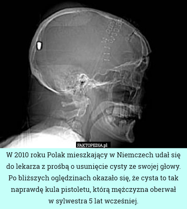 W 2010 roku Polak mieszkający w Niemczech udał się do lekarza z prośbą o usunięcie cysty ze swojej głowy. Po bliższych oględzinach okazało się, że cysta to tak naprawdę kula pistoletu, którą mężczyzna oberwał
w sylwestra 5 lat wcześniej. 