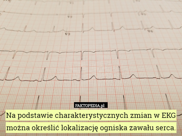 Na podstawie charakterystycznych zmian w EKG można określić lokalizację ogniska zawału serca. 