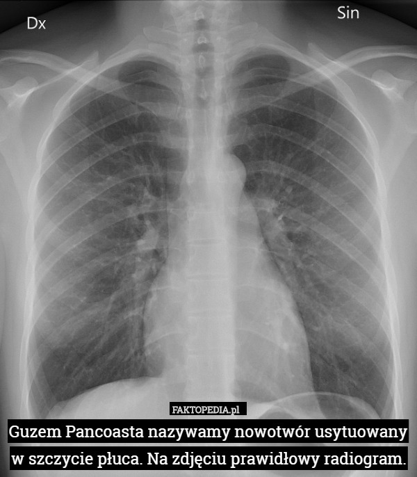 Guzem Pancoasta nazywamy nowotwór usytuowany w szczycie płuca. Na zdjęciu prawidłowy radiogram. 