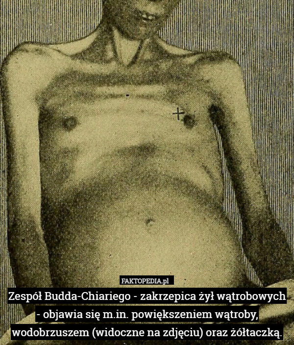 Zespół Budda-Chiariego - zakrzepica żył wątrobowych - objawia się m.in. powiększeniem wątroby, wodobrzuszem (widoczne na zdjęciu) oraz żółtaczką. 