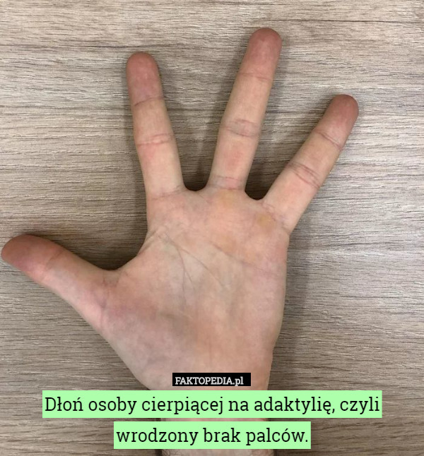 Dłoń osoby cierpiącej na adaktylię, czyli wrodzony brak palców. 