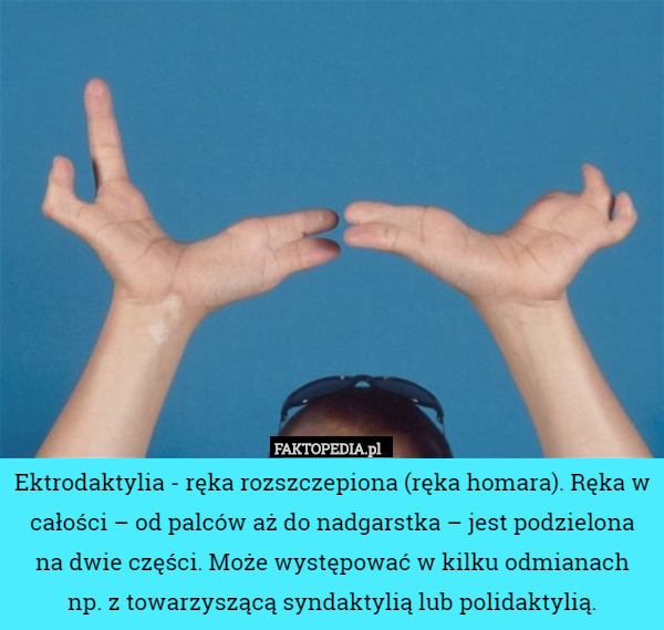 Ektrodaktylia - ręka rozszczepiona (ręka homara). Ręka w całości – od palców aż do nadgarstka – jest podzielona na dwie części. Może występować w kilku odmianach
 np. z towarzyszącą syndaktylią lub polidaktylią. 