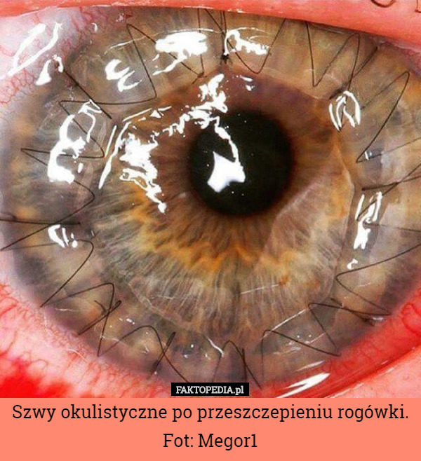 Szwy okulistyczne po przeszczepieniu rogówki.
Fot: Megor1 