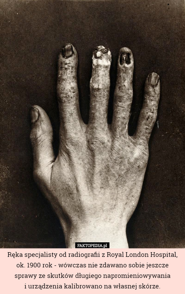 Ręka specjalisty od radiografii z Royal London Hospital, ok. 1900 rok - wówczas nie zdawano sobie jeszcze sprawy ze skutków długiego napromieniowywania
 i urządzenia kalibrowano na własnej skórze. 
