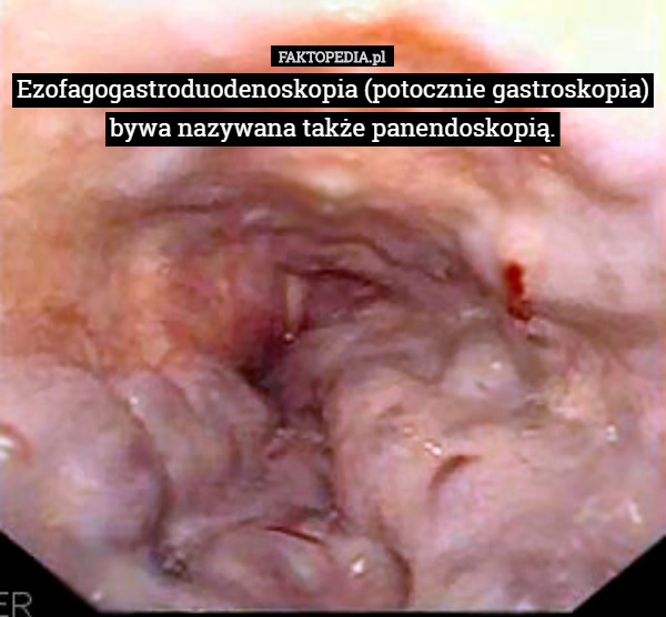 Ezofagogastroduodenoskopia (potocznie gastroskopia) bywa nazywana także panendoskopią. 