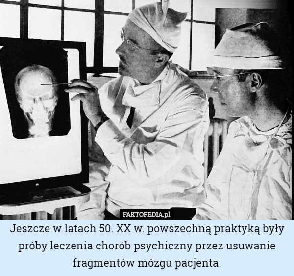Jeszcze w latach 50. XX w. powszechną praktyką były próby leczenia chorób psychiczny przez usuwanie fragmentów mózgu pacjenta. 