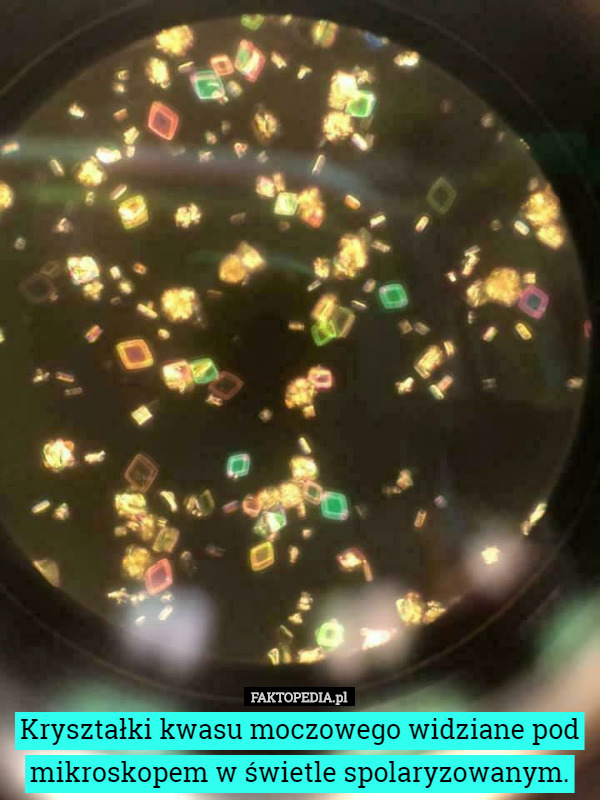 Kryształki kwasu moczowego widziane pod mikroskopem w świetle spolaryzowanym. 