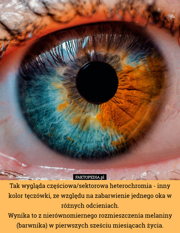 Tak wygląda częściowa/sektorowa heterochromia - inny kolor tęczówki, ze względu na zabarwienie jednego oka w różnych odcieniach.
Wynika to z nierównomiernego rozmieszczenia melaniny (barwnika) w pierwszych sześciu miesiącach życia. 