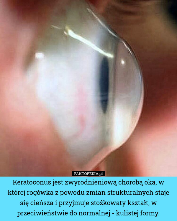 Keratoconus jest zwyrodnieniową chorobą oka, w której rogówka z powodu zmian strukturalnych staje się cieńsza i przyjmuje stożkowaty kształt, w przeciwieństwie do normalnej - kulistej formy. 