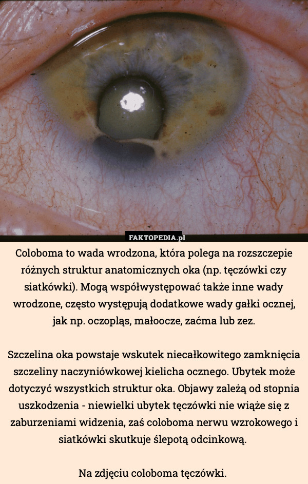Coloboma to wada wrodzona, która polega na rozszczepie różnych struktur anatomicznych oka (np. tęczówki czy siatkówki). Mogą współwystępować także inne wady wrodzone, często występują dodatkowe wady gałki ocznej, jak np. oczopląs, małoocze, zaćma lub zez.

Szczelina oka powstaje wskutek niecałkowitego zamknięcia szczeliny naczyniówkowej kielicha ocznego. Ubytek może dotyczyć wszystkich struktur oka. Objawy zależą od stopnia uszkodzenia - niewielki ubytek tęczówki nie wiąże się z zaburzeniami widzenia, zaś coloboma nerwu wzrokowego i siatkówki skutkuje ślepotą odcinkową. 

Na zdjęciu coloboma tęczówki. 