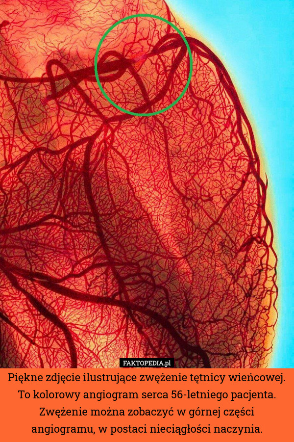 Piękne zdjęcie ilustrujące zwężenie tętnicy wieńcowej. To kolorowy angiogram serca 56-letniego pacjenta. Zwężenie można zobaczyć w górnej części angiogramu, w postaci nieciągłości naczynia. 