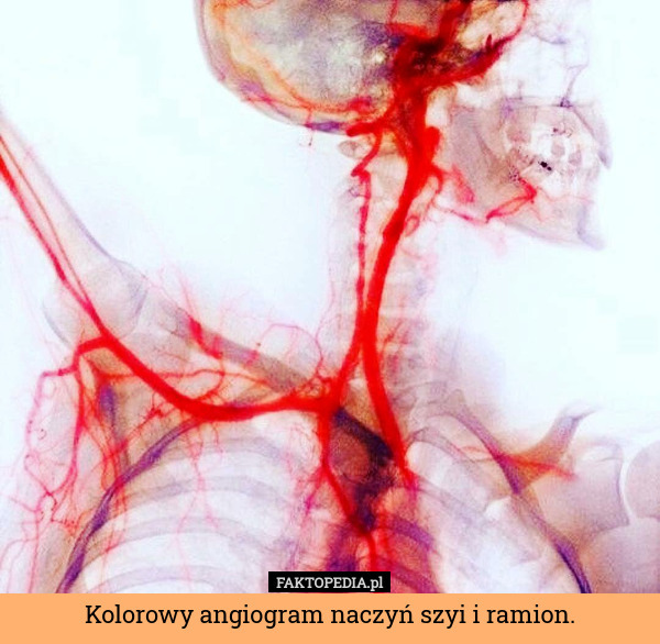 Kolorowy angiogram naczyń szyi i ramion. 