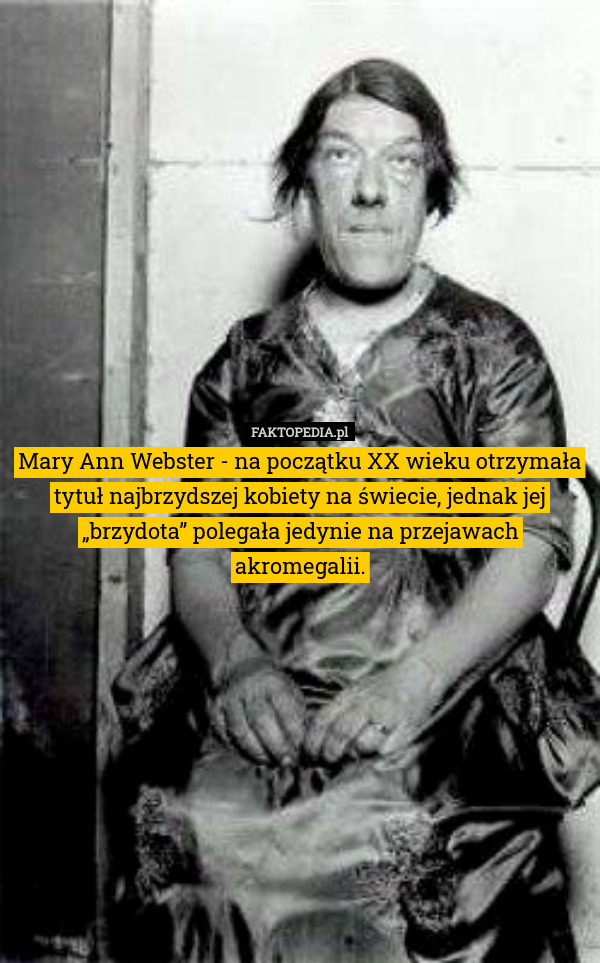 Mary Ann Webster - na początku XX wieku otrzymała tytuł najbrzydszej kobiety na świecie, jednak jej „brzydota” polegała jedynie na przejawach akromegalii. 